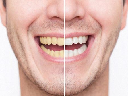 An image of teeth, before and after teeth whitening