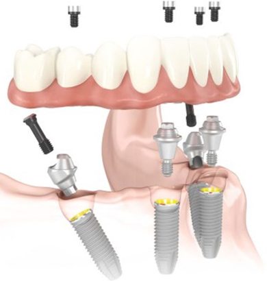 All on 4 dental implants diagram.